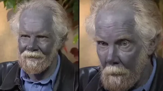 Cet homme présente une coloration bleue de la peau qui est apparue après une utilisation prolongée de compléments alimentaires