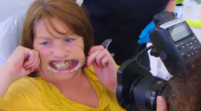 Une femme terrifiée par les dentistes se recolle les dents à la glue en Angleterre