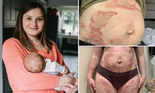 Une allergie insolite : cette femme découvre qu'elle est allergique à son propre bébé pendant sa grossesse