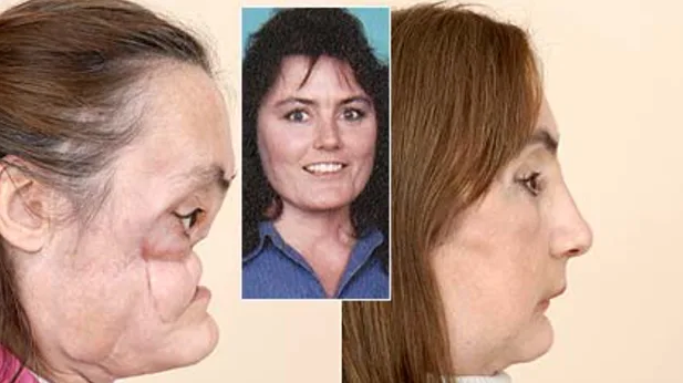 Connie Culp, la première patiente américaine ayant subi une greffe de visage : Retour sur une histoire incroyable