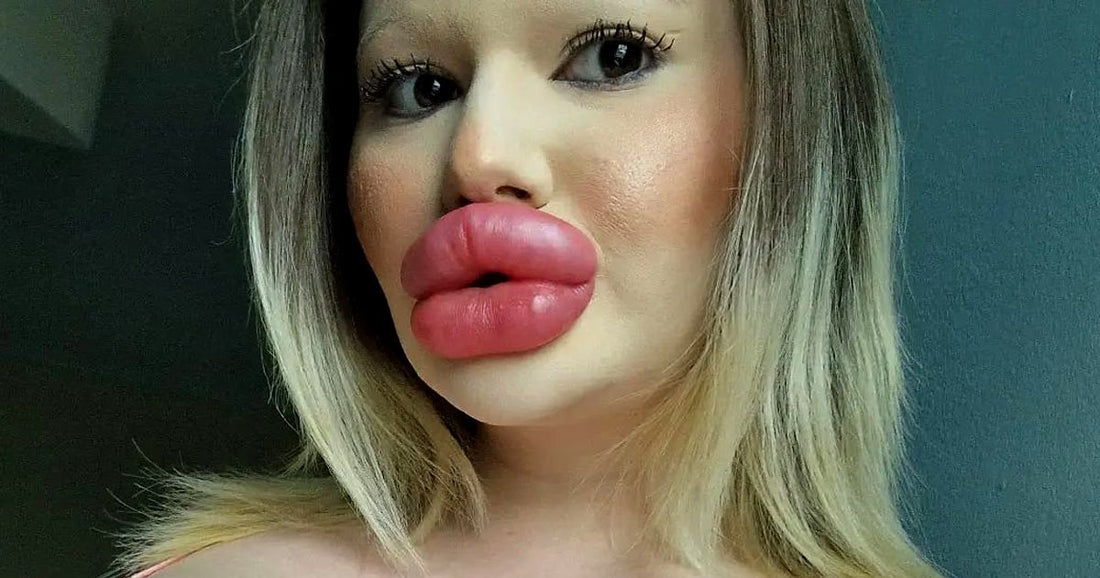 Elle dépense une fortune pour avoir les lèvres les plus pulpeuses du monde : plus de 8000 € !