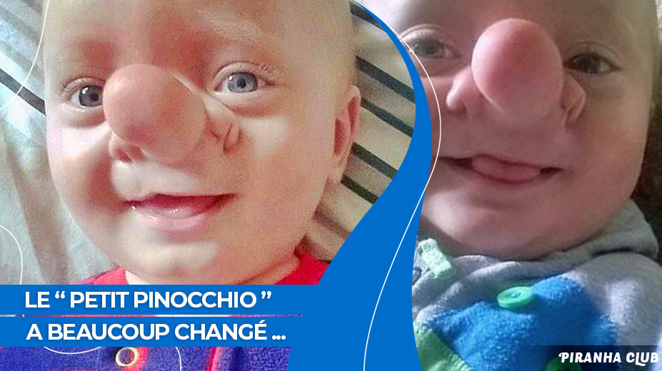 Le " petit Pinocchio " était rejeté à cause de son nez. Vous n'en croirez pas vos yeux en découvrant son nouveau visage 8 ans plus tard ...