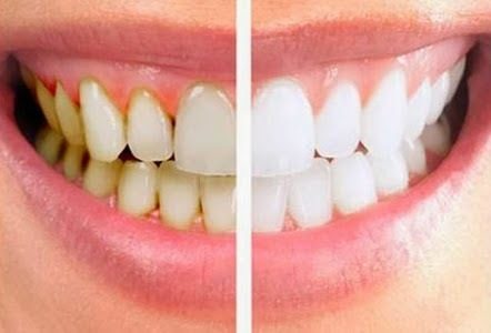 Élimination de la plaque dentaire : 6 techniques naturelles